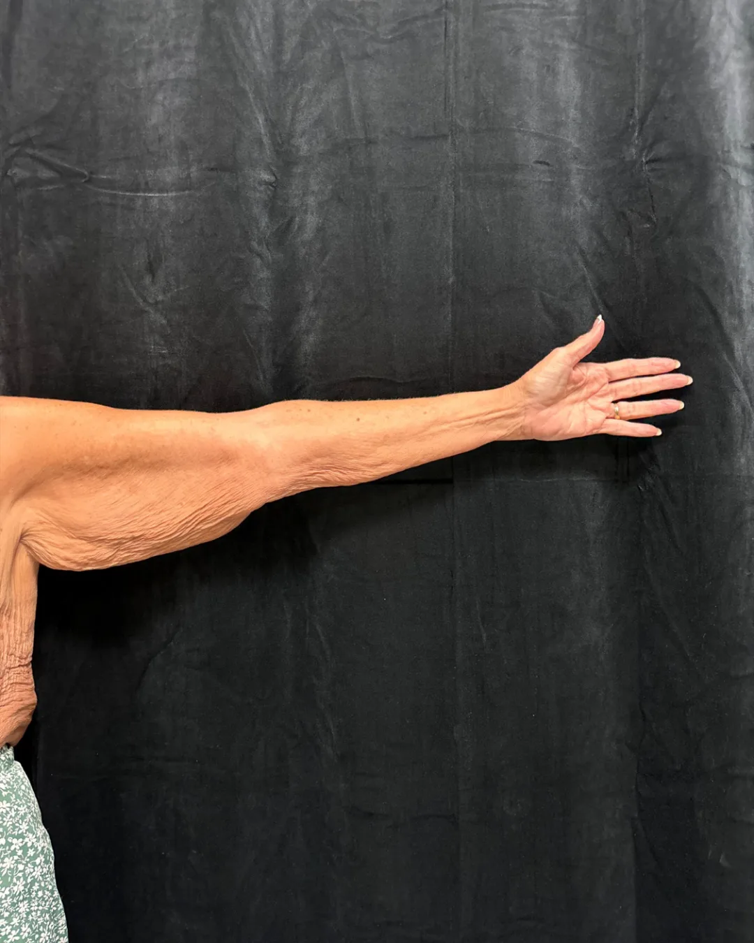Brachioplasty (Arm Lift) — before