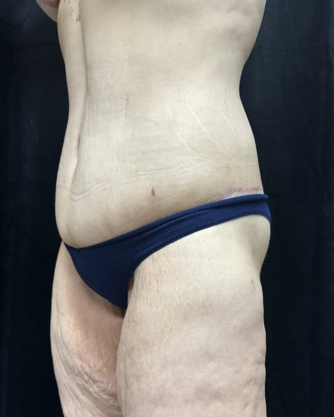 Lower Body Lift — after