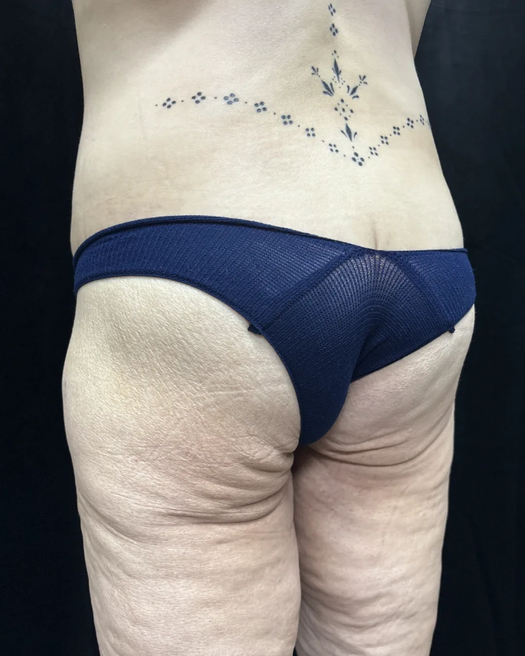 Lower Body Lift — after