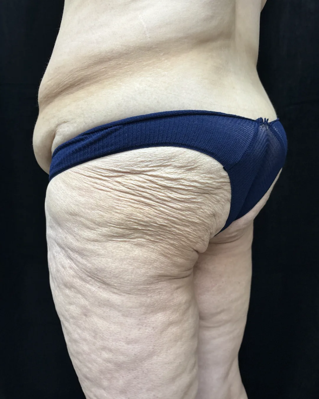 Lower Body Lift — before