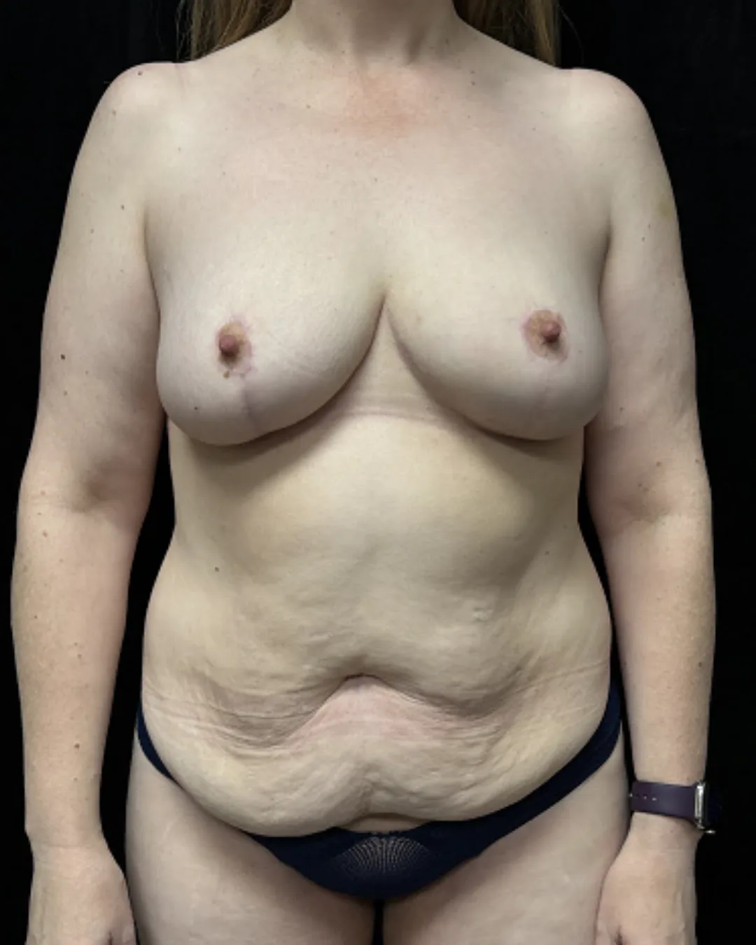 Breast Reduction — after