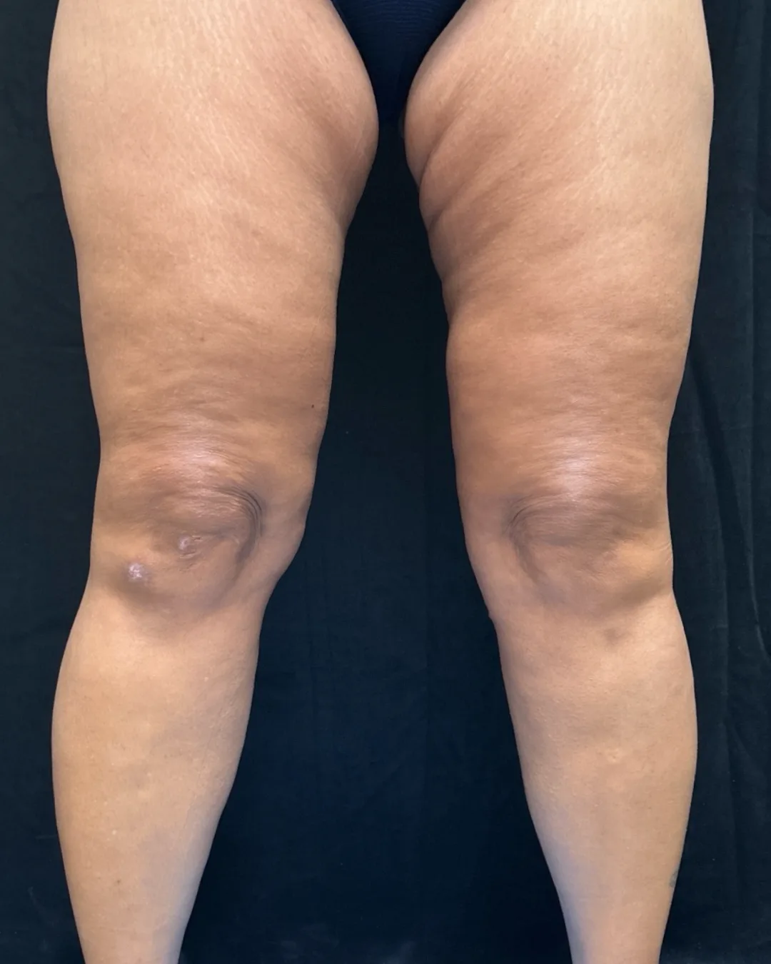Thigh Lift — after
