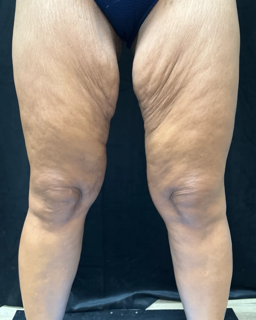 Thigh Lift — before