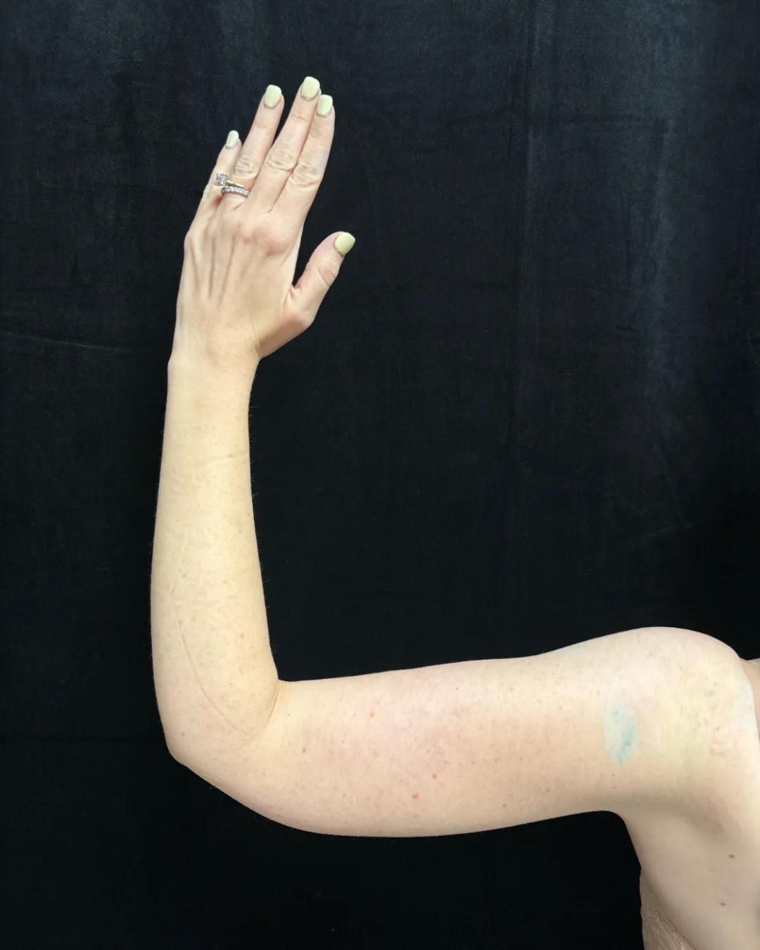 Brachioplasty (Arm Lift) — after