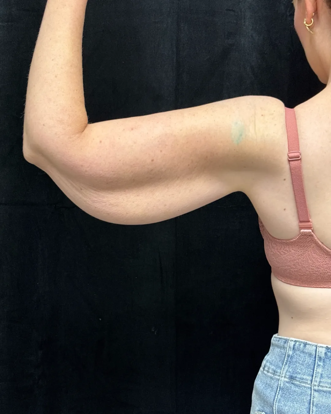 Brachioplasty (Arm Lift) — before
