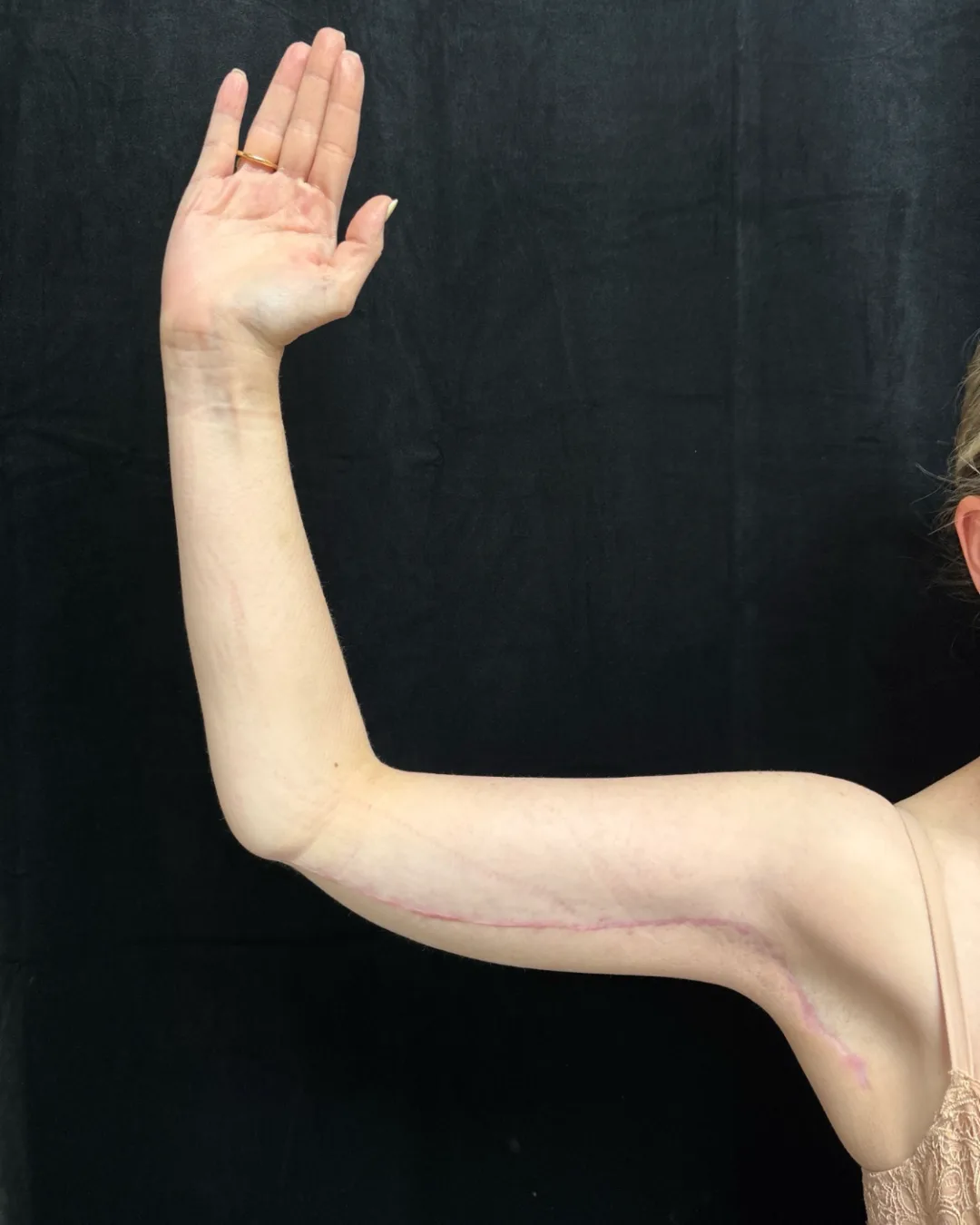 Brachioplasty (Arm Lift) — after