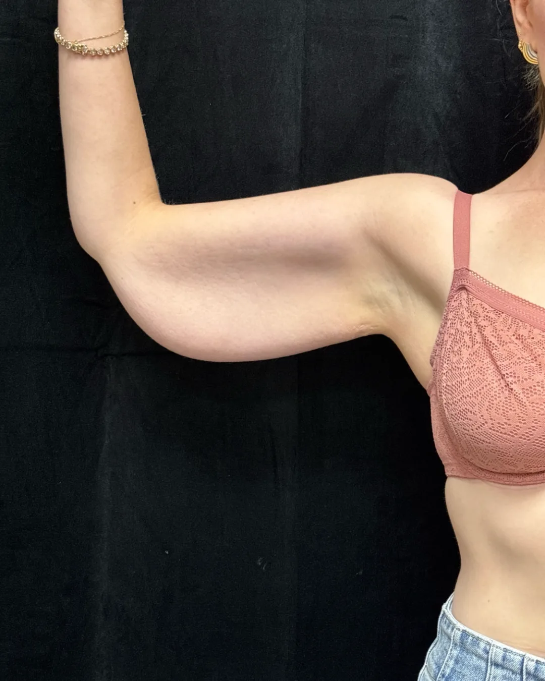 Brachioplasty (Arm Lift) — before