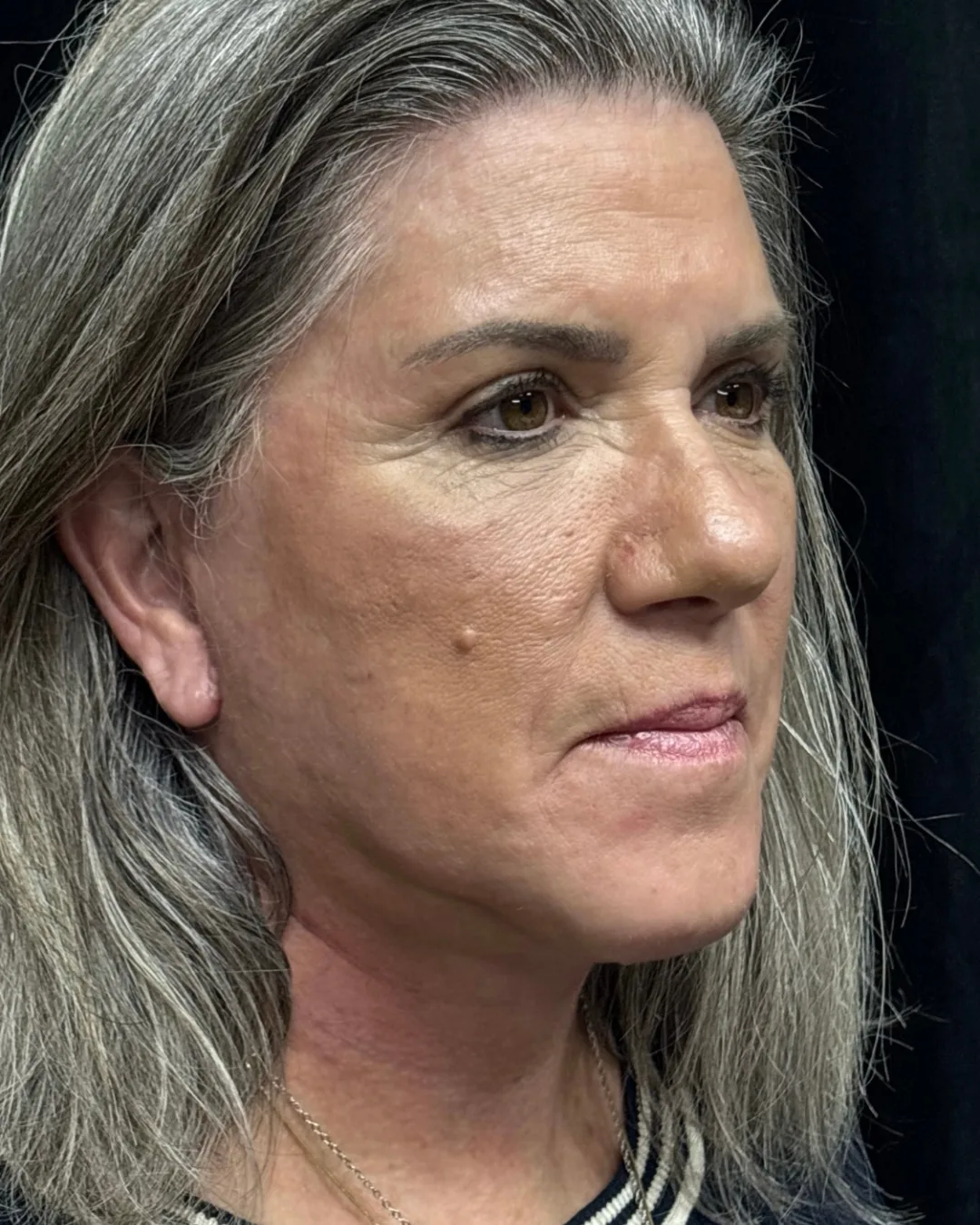 Facelift & Upper Blepharoplasty — after