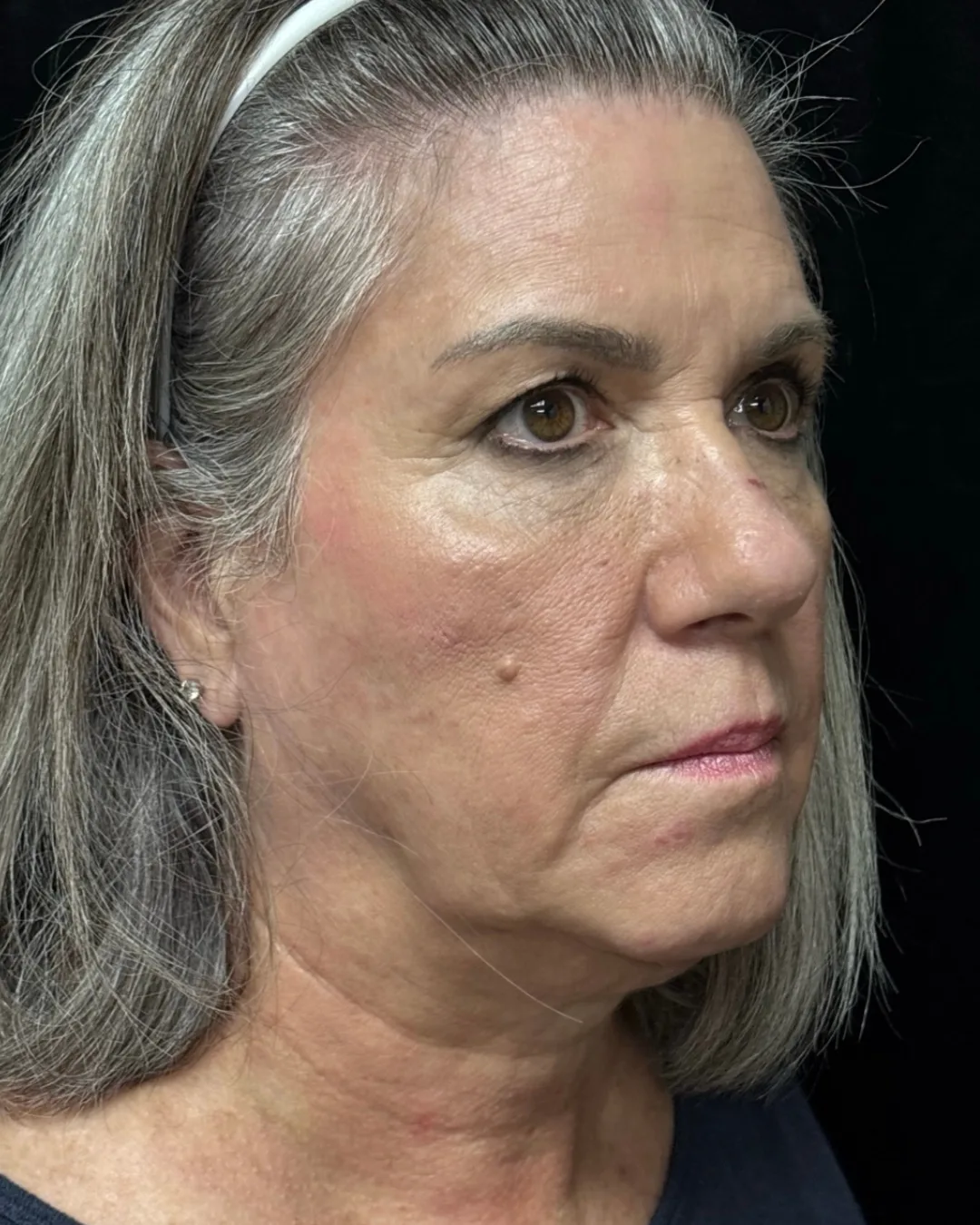 Facelift & Upper Blepharoplasty — before