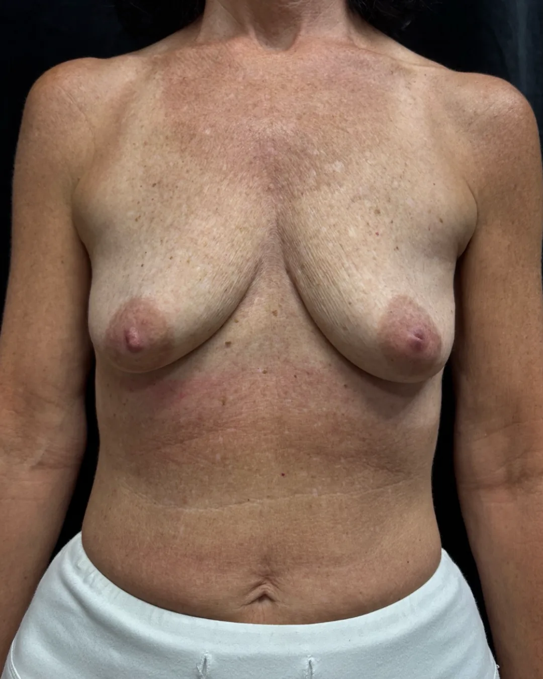 Breast Augmentation (365cc full-profile submuscular) — before
