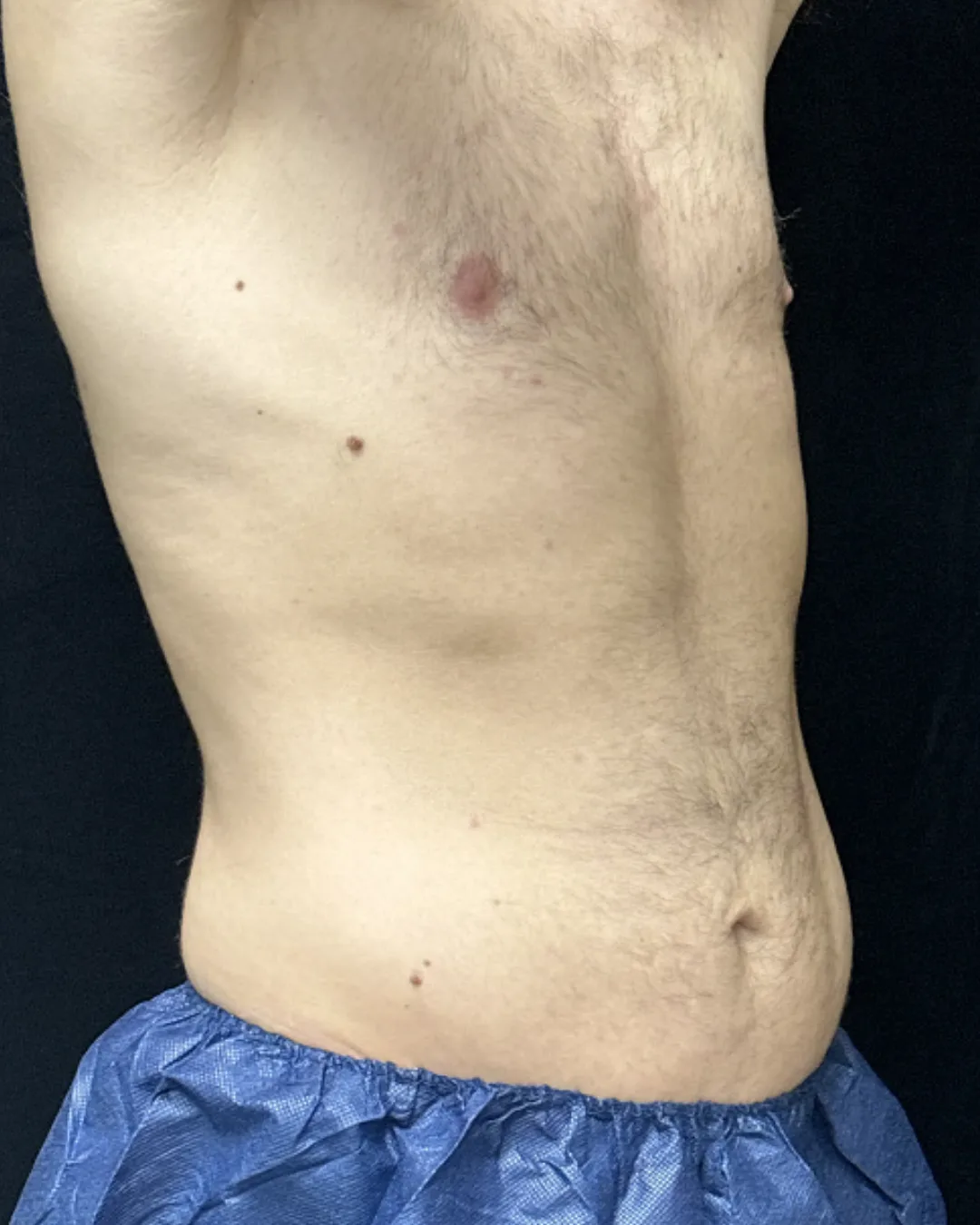 Tummy Tuck (male) — after
