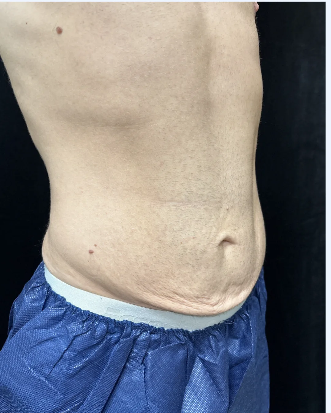 Tummy Tuck (male) — before