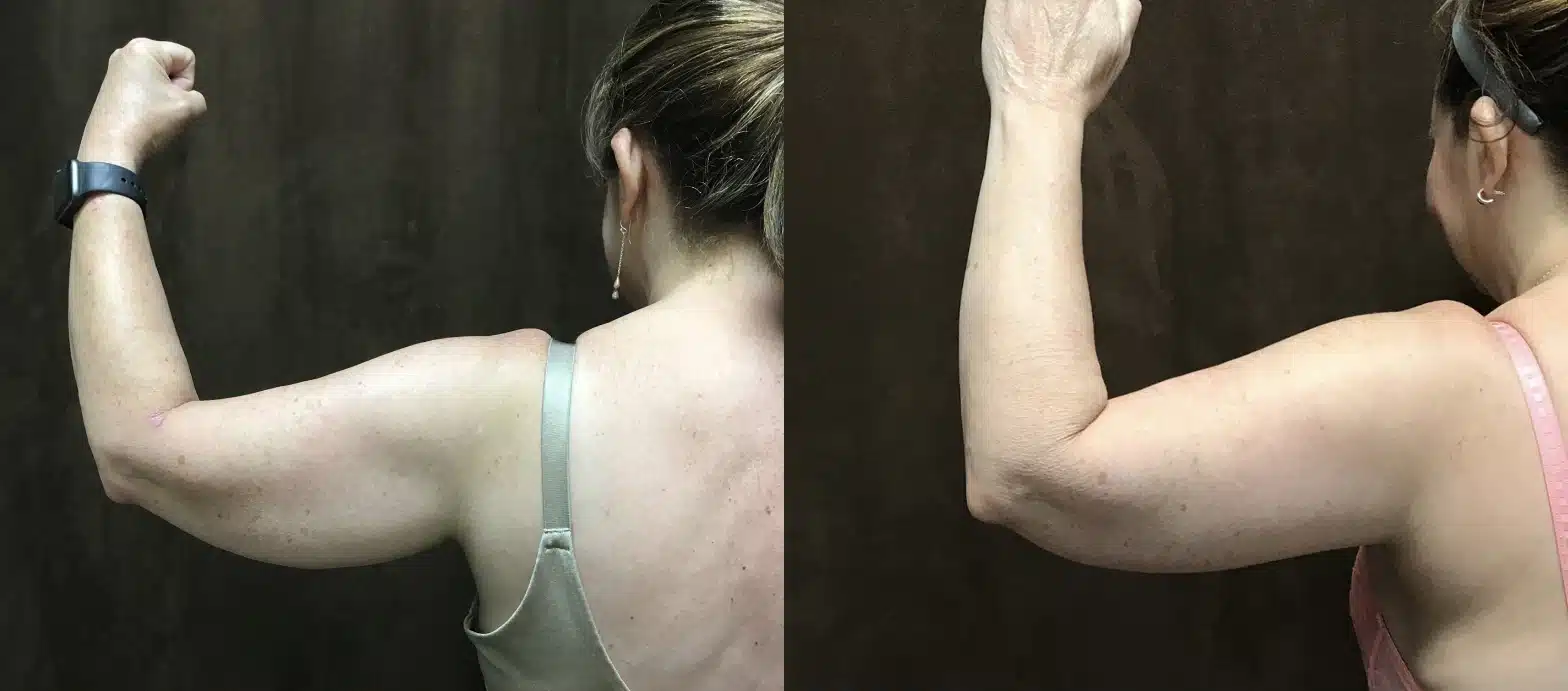 Arm Lift (Brachioplasty) before and after, case 253052: before on the left, after on the right
