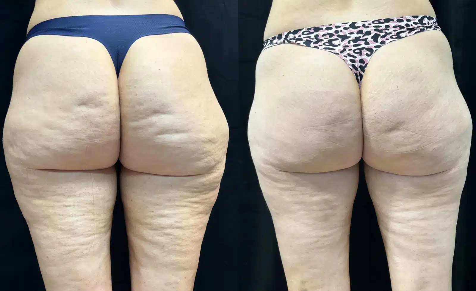 Avéli (Cellulite Removal) before and after, case 253054, view 1 of 2: before on the left, after on the right
