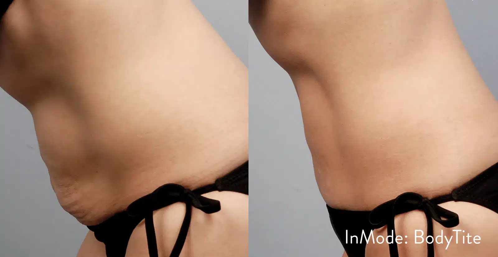 BodyTite before and after, case 253060: before on the left, after on the right