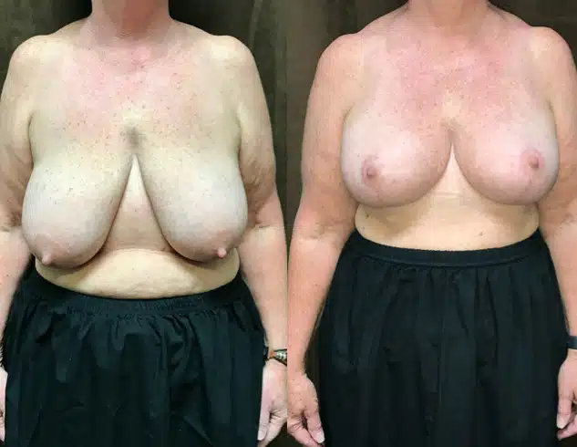 Breast Lift (Mastopexy) before and after, case 253227, view 1 of 2: before on the left, after on the right
