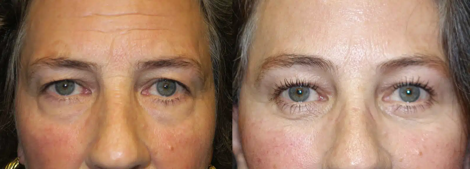 Brow Lift before and after, case 253259: before on the left, after on the right