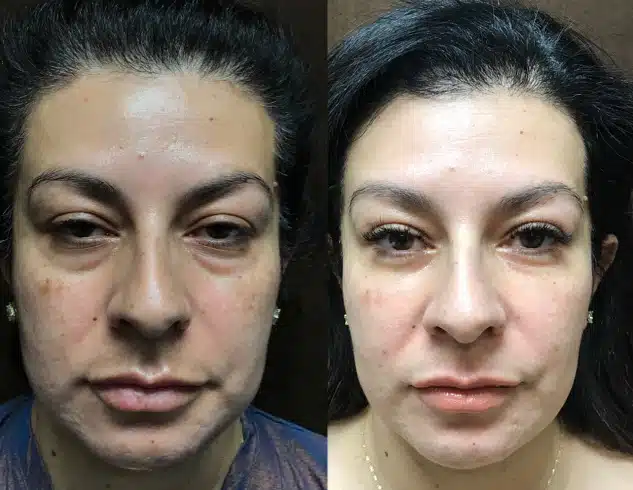 Eyelid Surgery before and after, case 253261: before on the left, after on the right