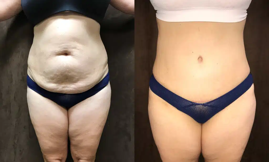 Liposuction before and after, case 253064, view 1 of 2: before on the left, after on the right