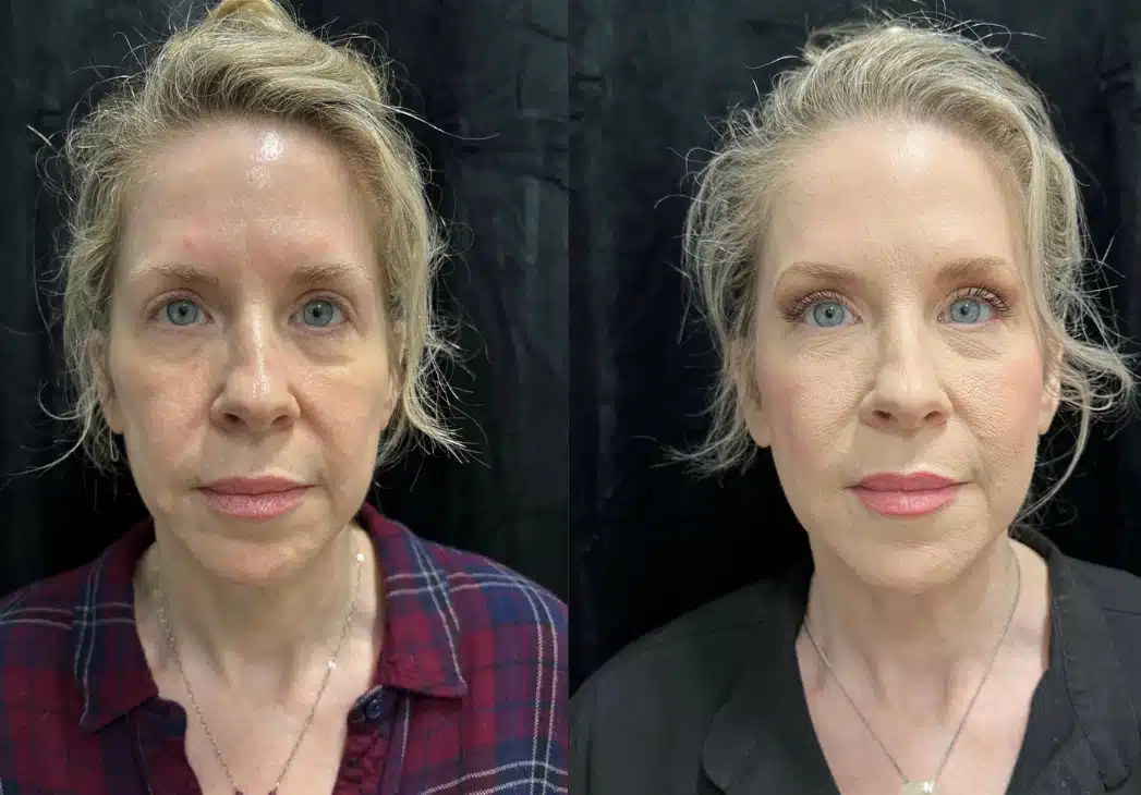 MyEllevate before and after, case 253281, view 1 of 2: before on the left, after on the right