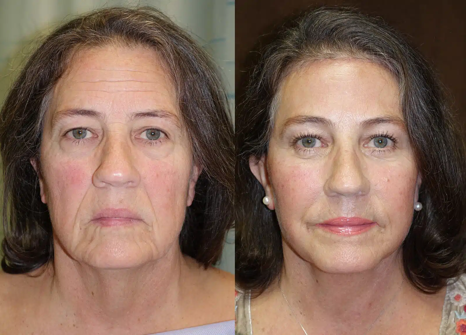 Neck Lift before and after, case 253289: before on the left, after on the right