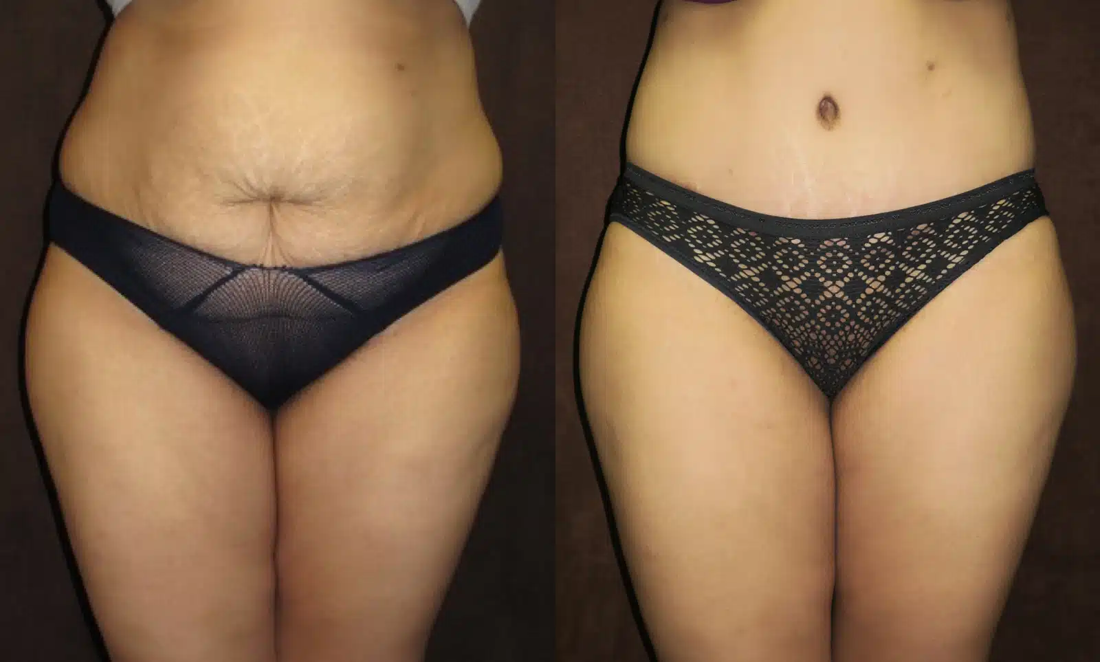 Tummy Tuck before and after, case 253097, view 1 of 2: before on the left, after on the right