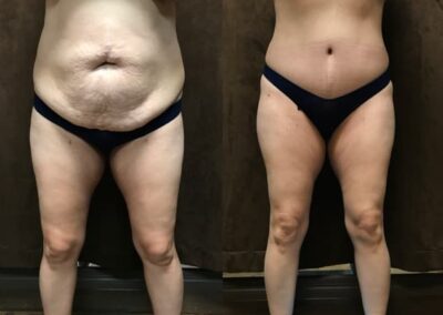Mommy Makeover before and after photo