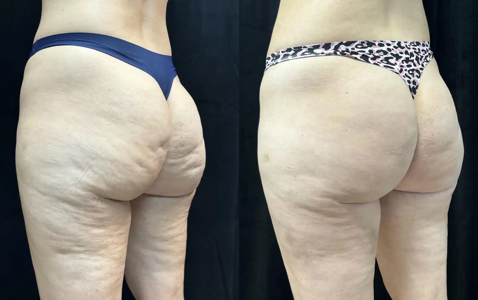 Avéli (Cellulite Removal) before and after, case 253054, view 2 of 2: before on the left, after on the right