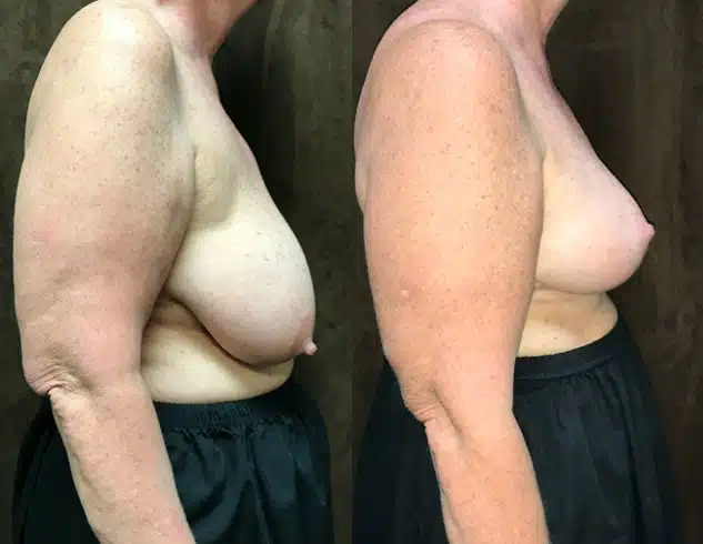 Breast Reduction before and after, case 253251, view 2 of 2: before on the left, after on the right
