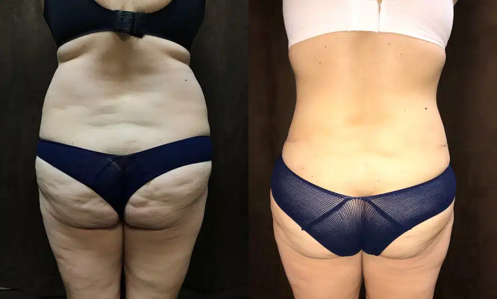 Liposuction before and after, case 253064, view 2 of 2: before on the left, after on the right