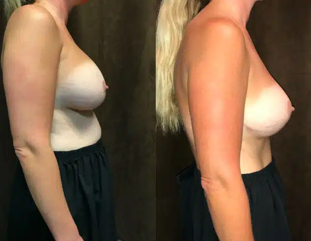 Mommy Makeover before and after, case 253066, view 2 of 2: before on the left, after on the right
