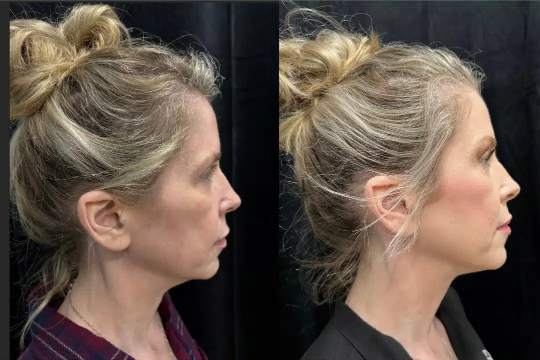MyEllevate before and after, case 253281, view 2 of 2: before on the left, after on the right