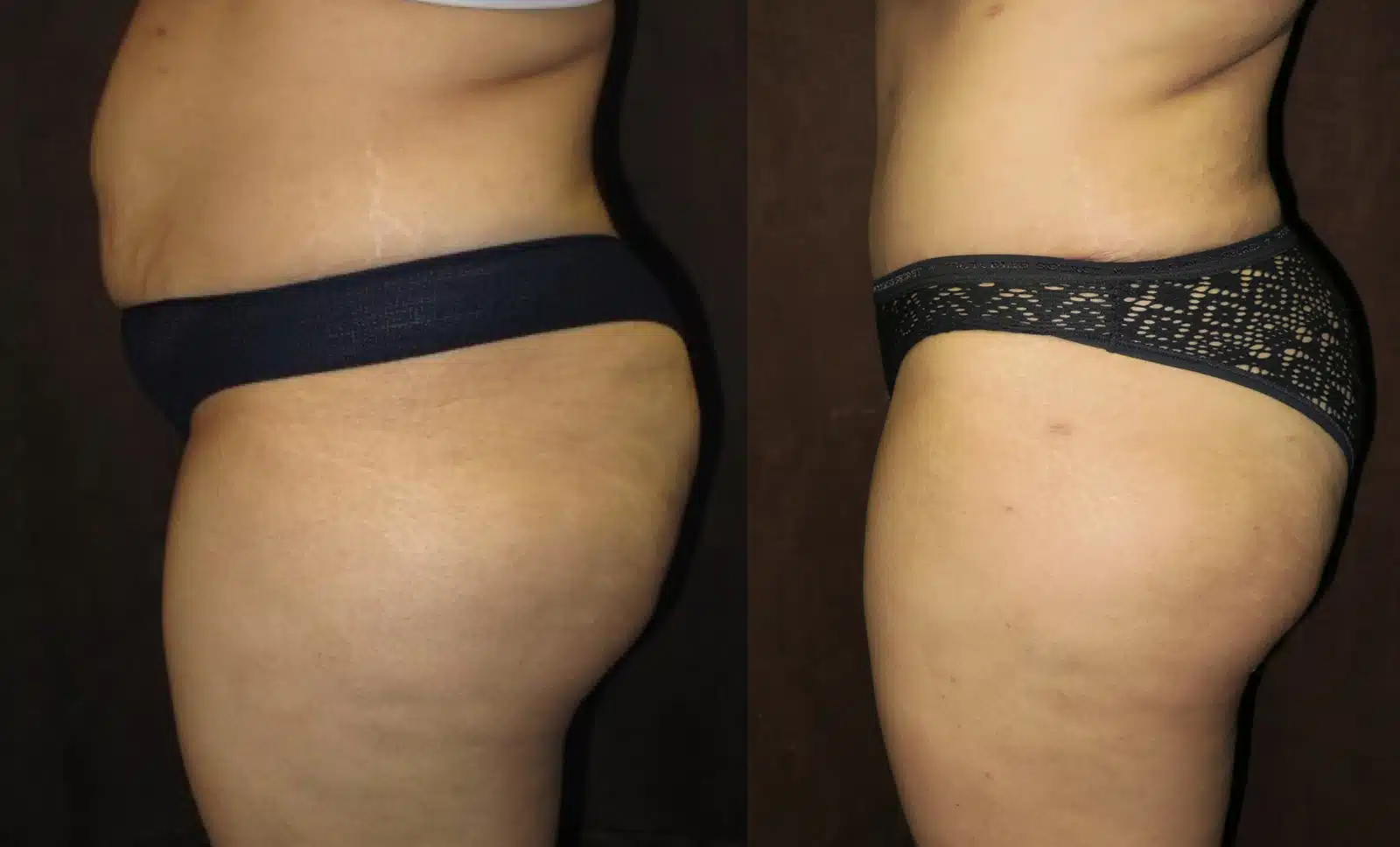 Tummy Tuck before and after, case 253097, view 2 of 2: before on the left, after on the right
