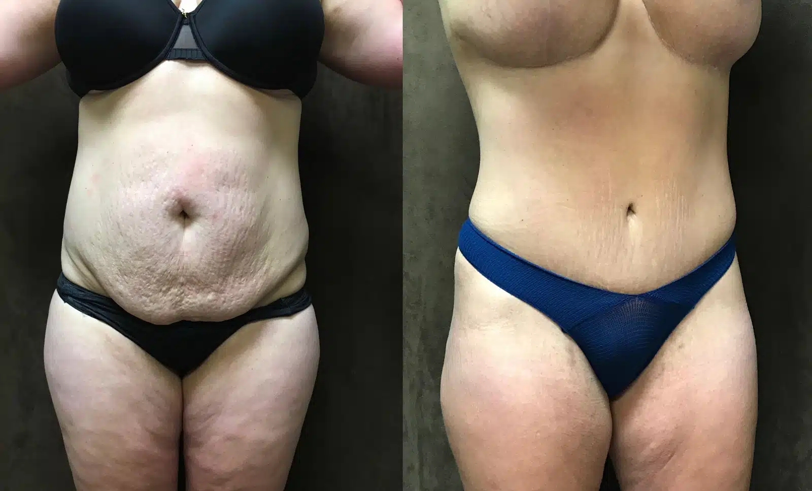 Tummy Tuck before and after, case 253115: before on the left, after on the right
