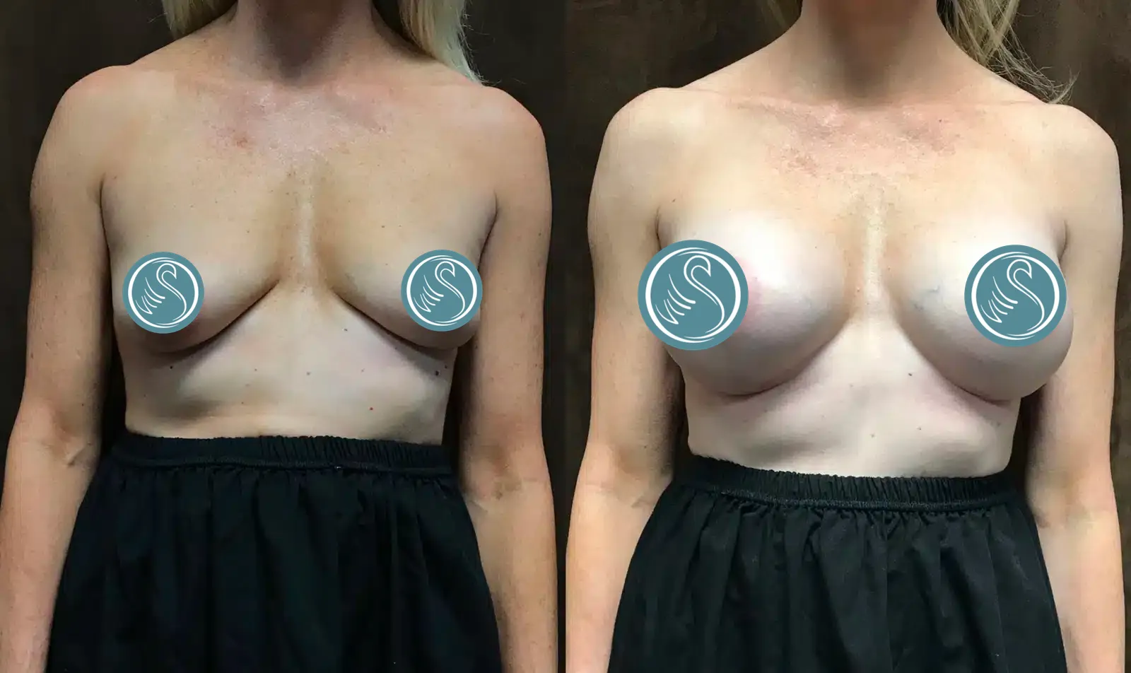 Breast Augmentation before and after, case 253214: before on the left, after on the right