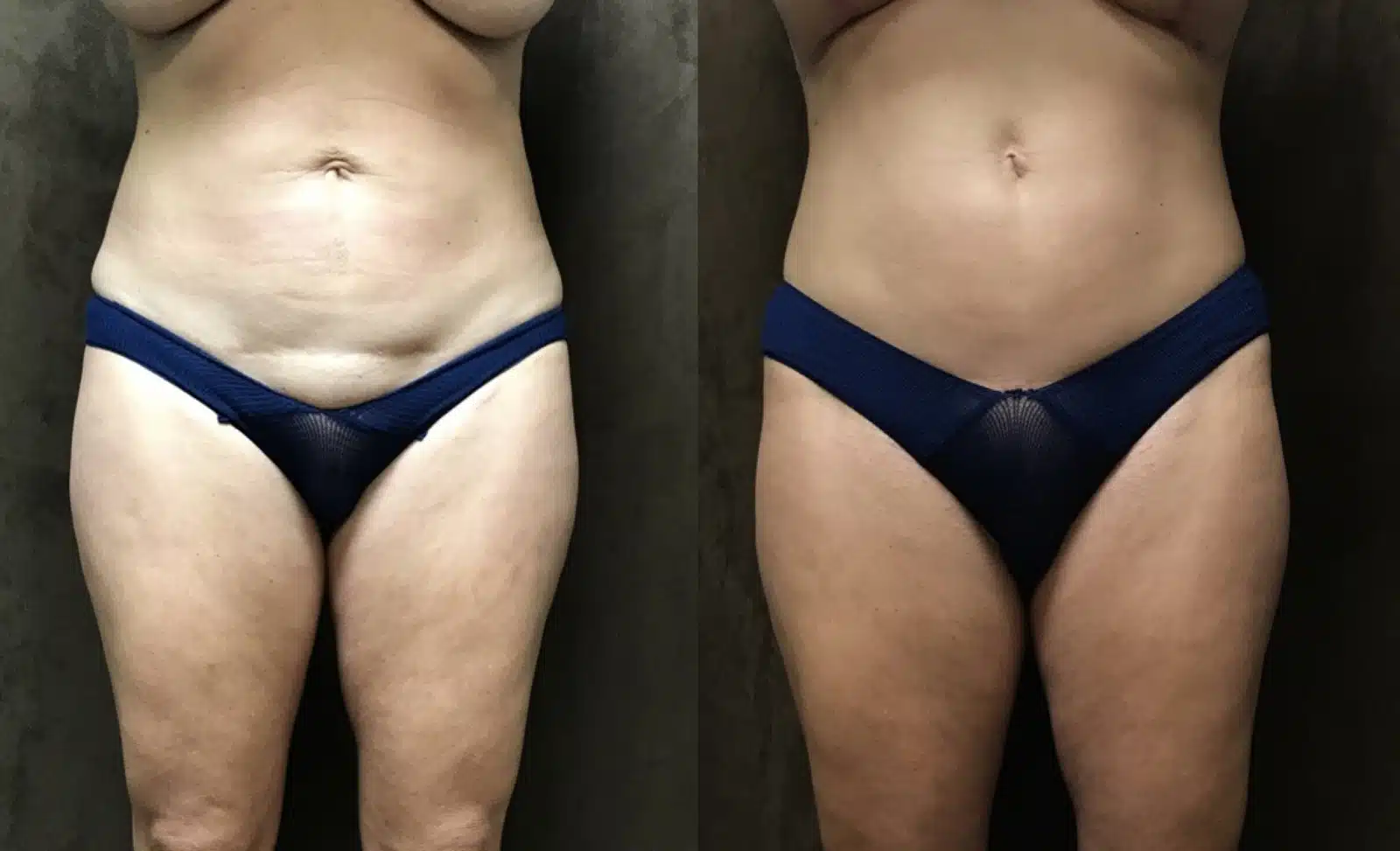 Tummy Tuck before and after, case 253148, view 1 of 2: before on the left, after on the right