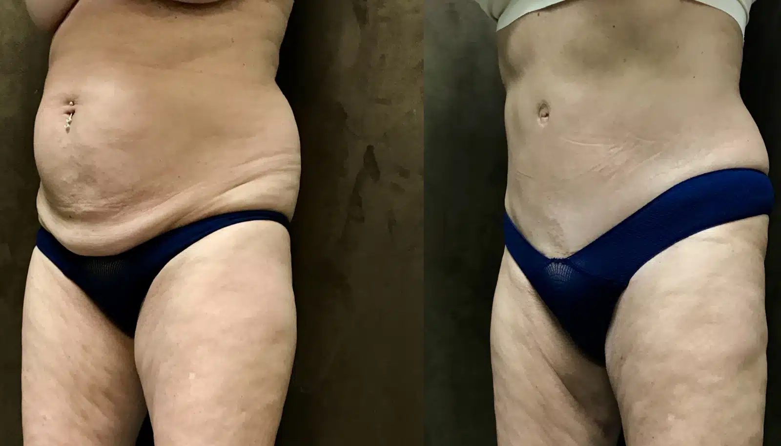 Tummy Tuck before and after, case 253148, view 2 of 2: before on the left, after on the right