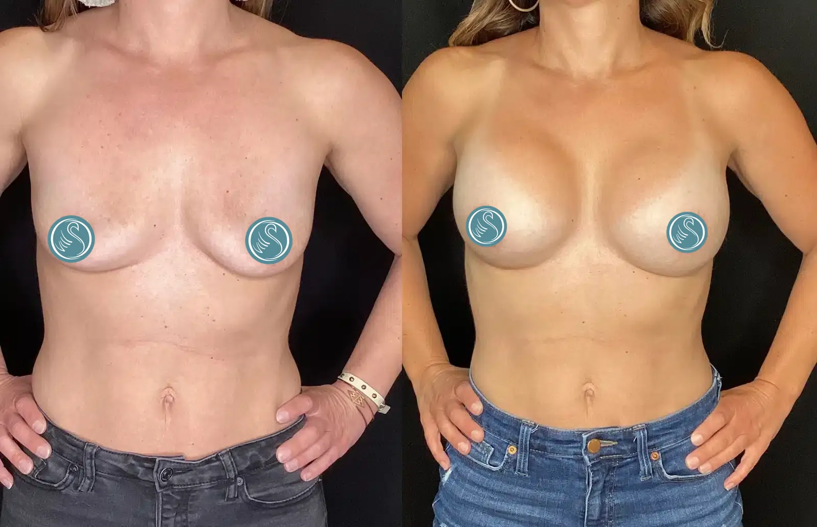 Breast Augmentation before and after, case 253215: before on the left, after on the right