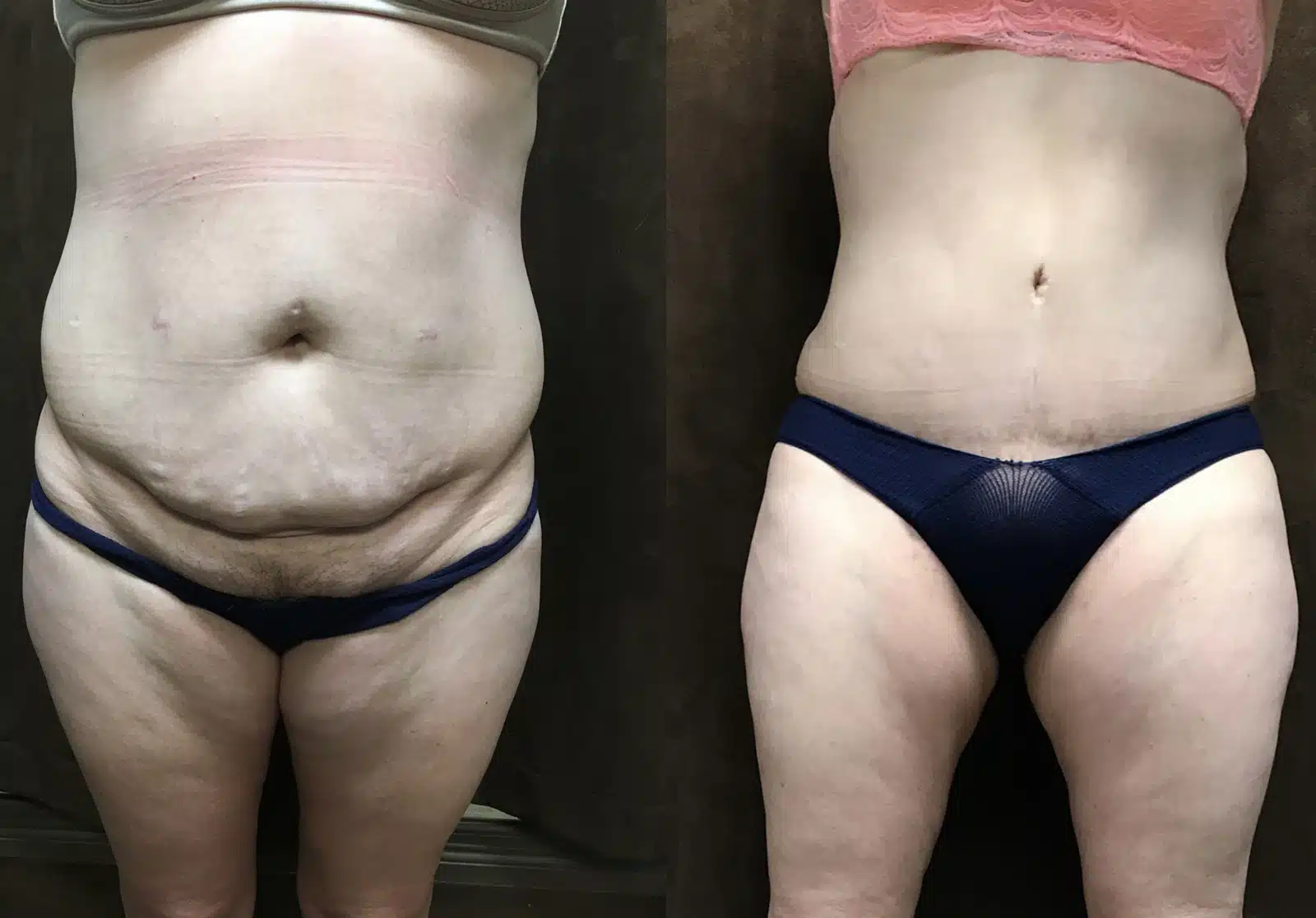 Tummy Tuck before and after, case 253150: before on the left, after on the right