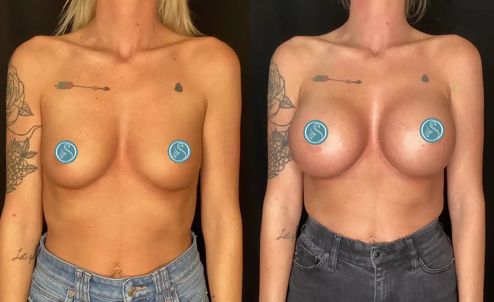 Breast Augmentation before and after, case 253217, view 1 of 2: before on the left, after on the right