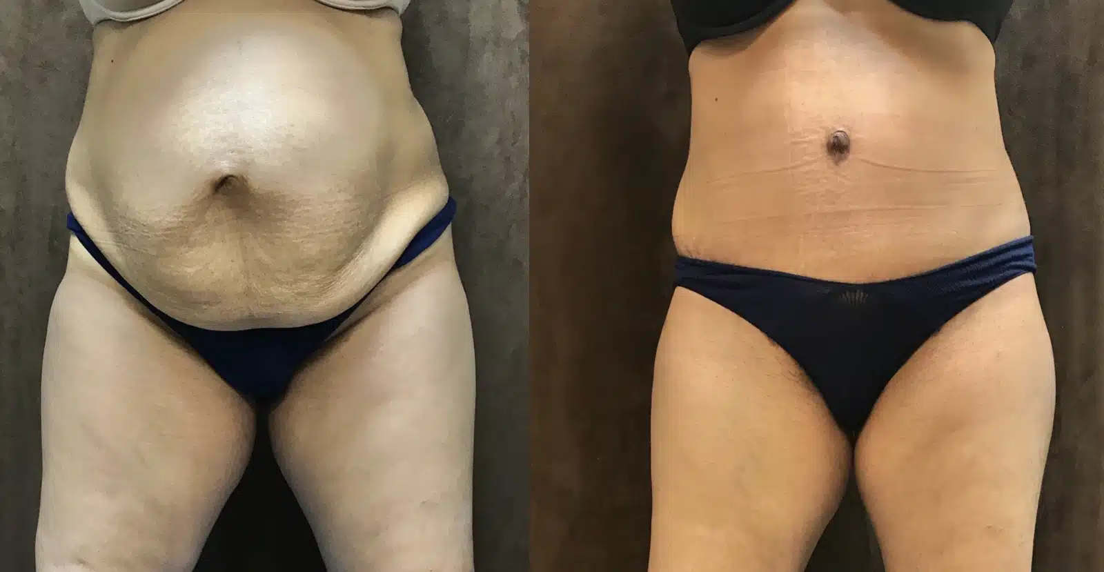 Tummy Tuck before and after, case 253153, view 1 of 2: before on the left, after on the right
