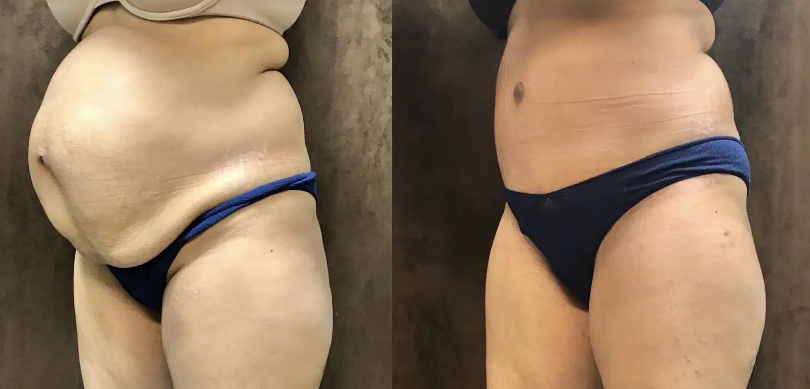 Tummy Tuck before and after, case 253153, view 2 of 2: before on the left, after on the right