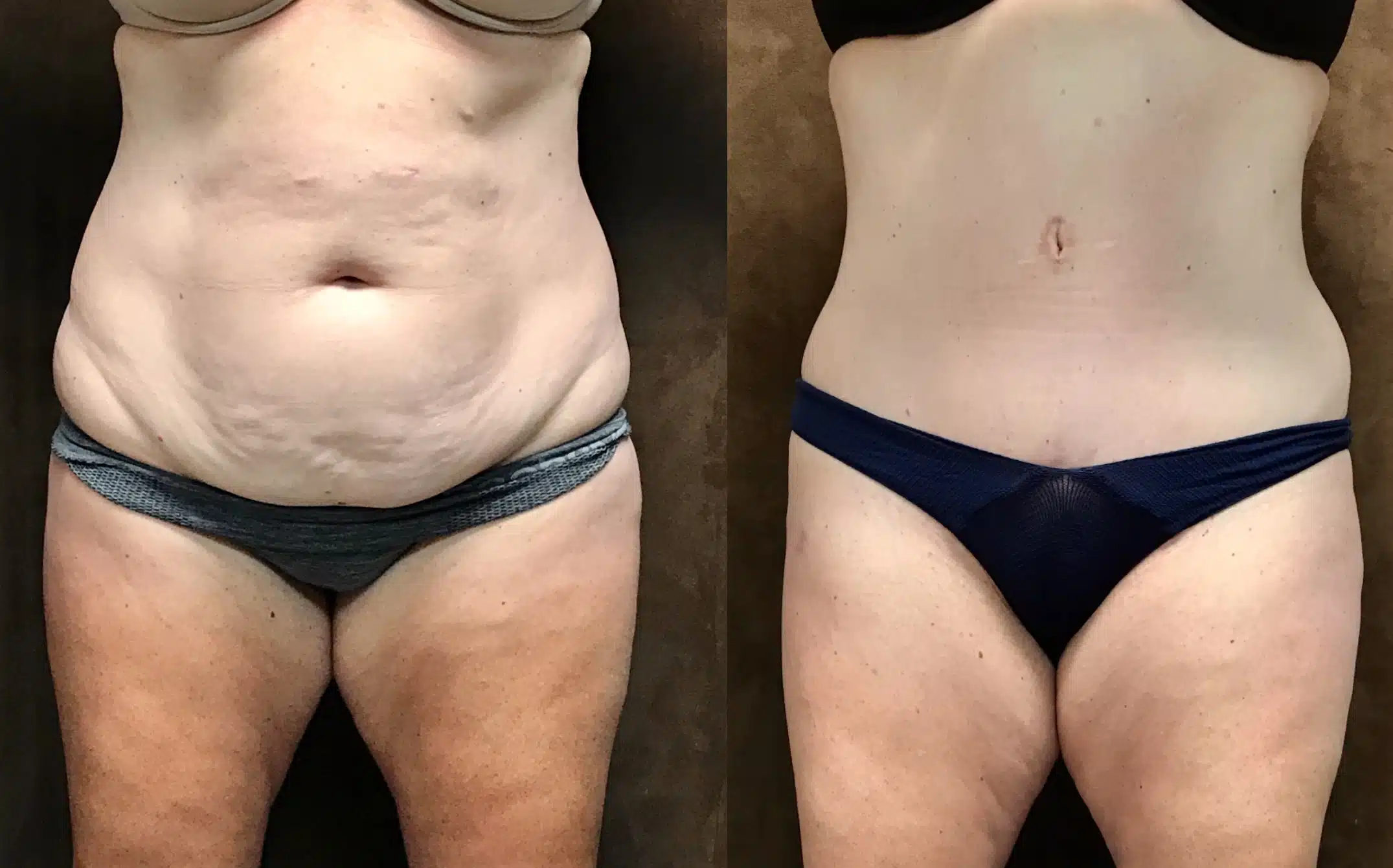 Tummy Tuck before and after, case 253162: before on the left, after on the right