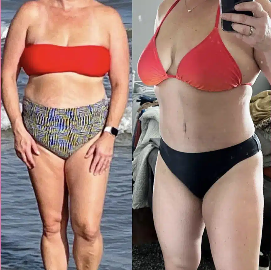 Tummy Tuck before and after, case 253163: before on the left, after on the right