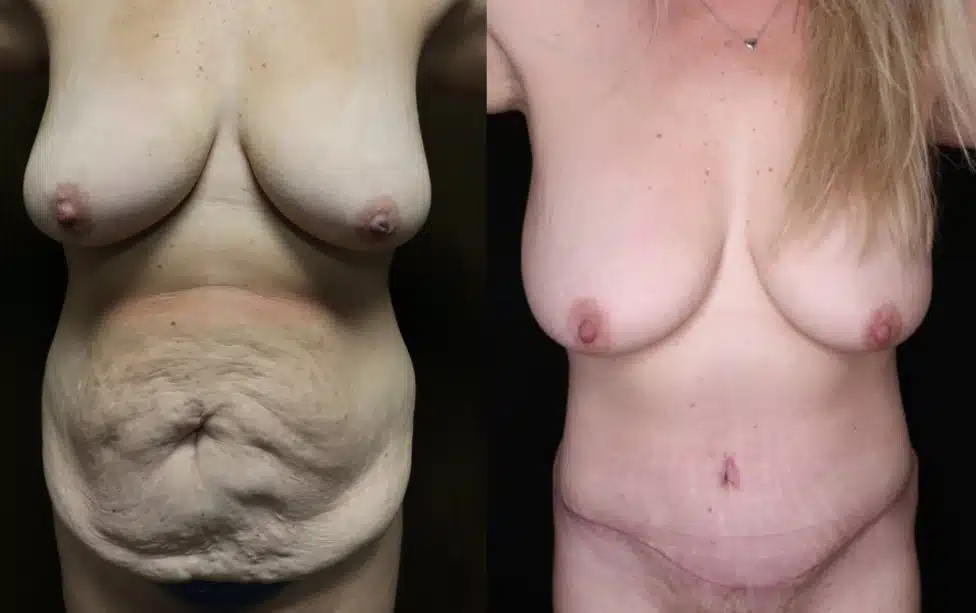Tummy Tuck before and after, case 253164: before on the left, after on the right