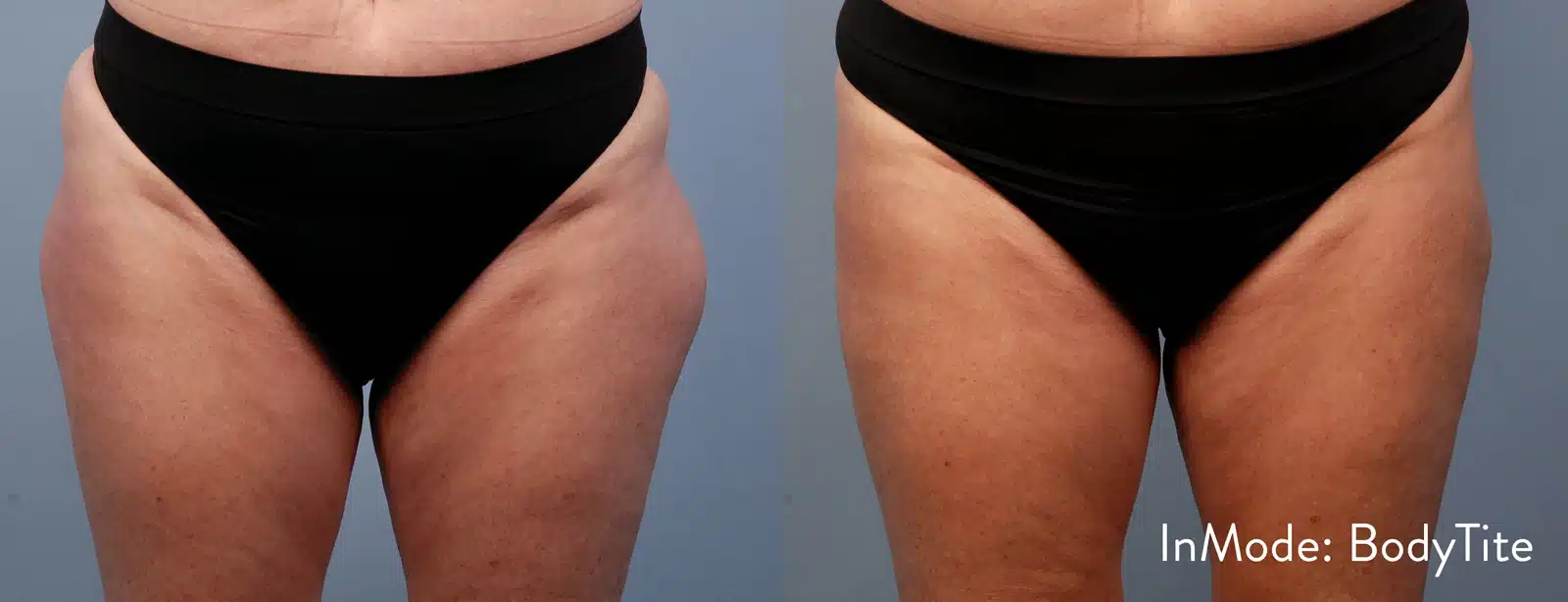 BodyTite before and after, case 253061: before on the left, after on the right