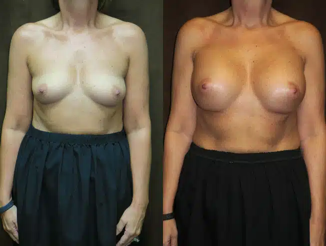 Breast Augmentation before and after, case 253185, view 1 of 2: before on the left, after on the right
