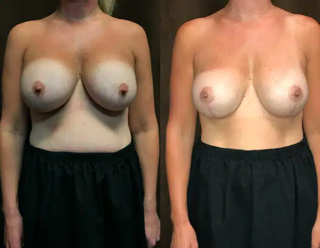 Breast Lift (Mastopexy) before and after, case 253228, view 1 of 2: before on the left, after on the right