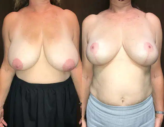 Breast Reduction before and after, case 253252: before on the left, after on the right