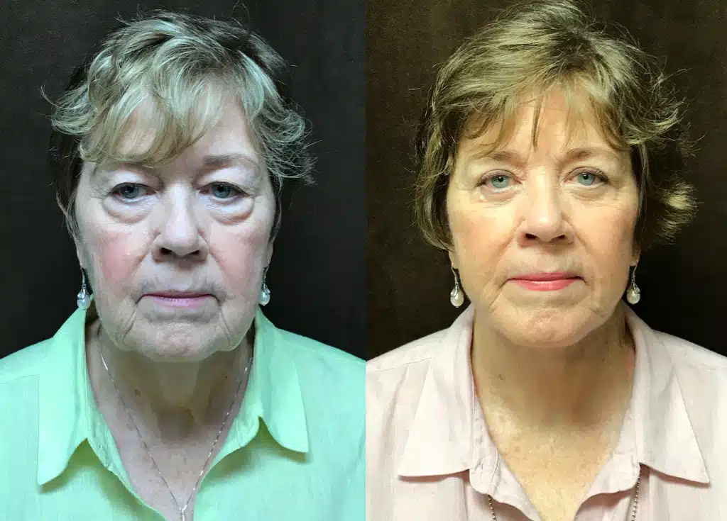 Facelift before and after, case 253268, view 1 of 2: before on the left, after on the right